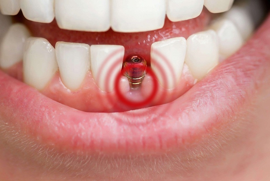 IMPIANTI DENTALI PROBLEMATICHE